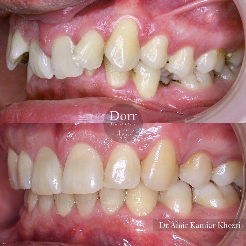  درمان همپوشانی شدید دندان‌های قدامی در بیماران بزرگسال که نیاز به کشیدن دندان هم دارند، جز سخت ترین درمان‌های ارتودنسی محسوب می شوند.
