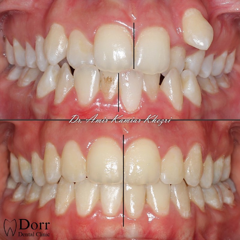 عکس قبل و بعد از ارتودنسی دندان های نامرتب