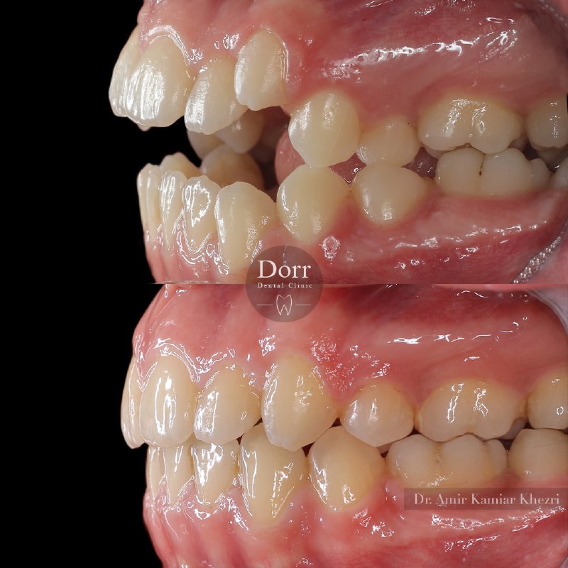 معجزه ارتودنسی (بدون جراحی فک) در بسته شدن فاصله دندان‌ها، زیبایی لبخند و مشخص شدن دندان‌های فک بالا
.
