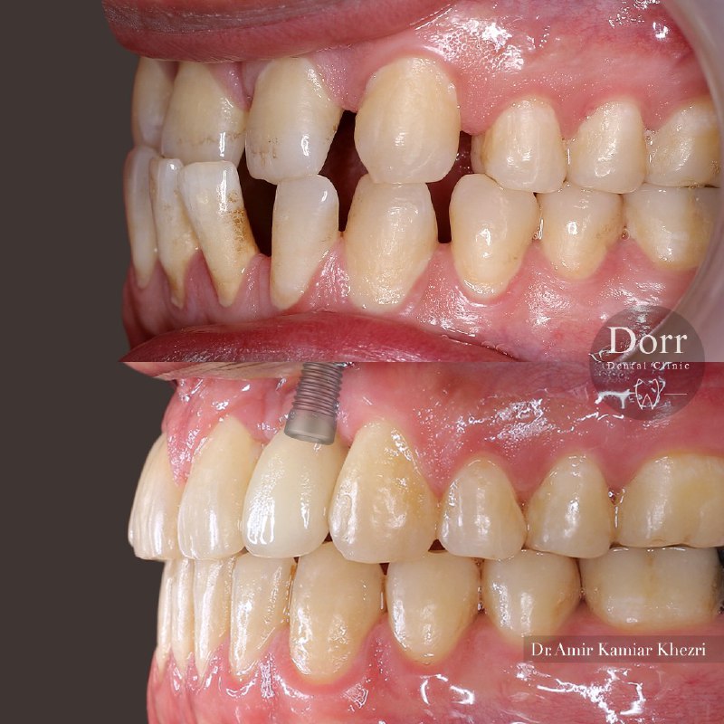 درمان ارتودنسی ثابت دو فک و تاثیر فوق العاده آن بر زیبایی لبخند و فانکشن بهتر دندان‌ها