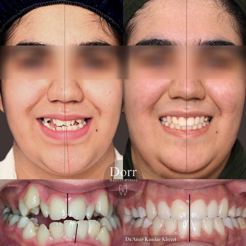 عکس ارتودنسی دندان ثابت قبل و بعد