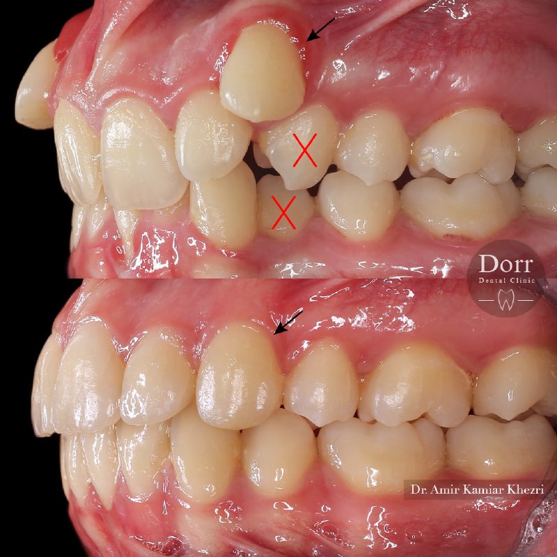  تاثیر درمان ارتودنسی ثابت بر زیبایی لبخند و همچنین در طی درمان ارتودنسی با انجام حرکات مناسب دندان‌ها، بدون انجام جراحی لثه، تحلیل لثه برطرف و اصلاح گردید.
.