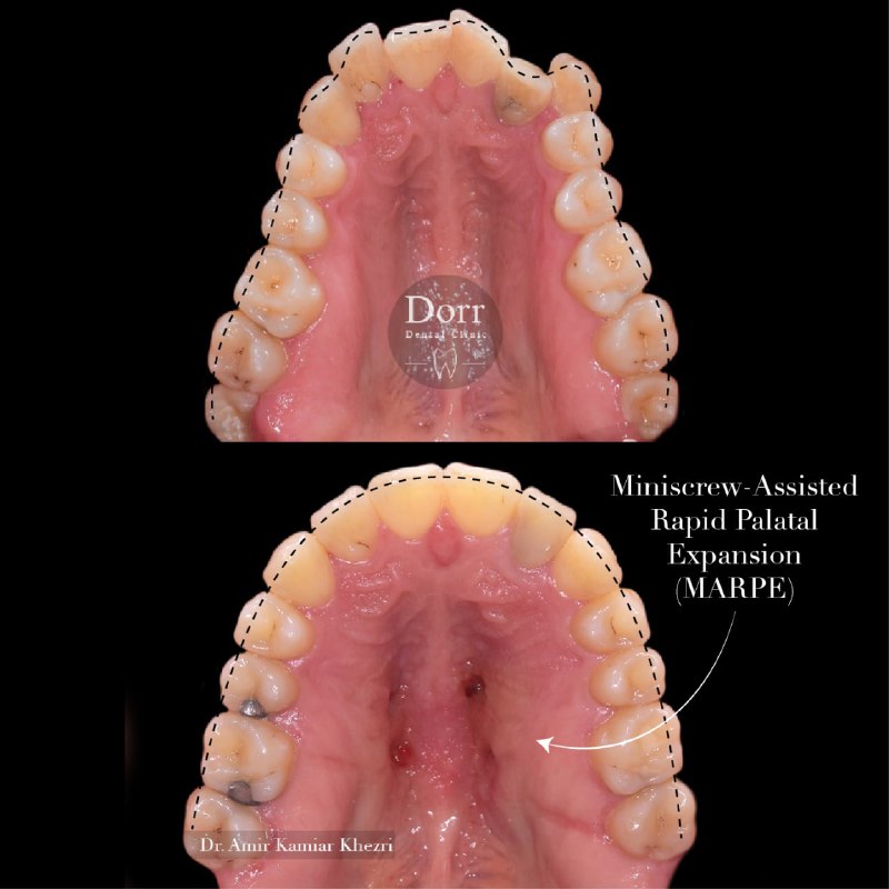 مراجعه کننده بزرگسال عزیزمون که دارای مشکل تنگی فک بالا همراه با open bite بودند، از تکنیک MARPE جهت افزایش عرض قوس فک بالا (بدون جراحی) و همچنین از mini screw جهت اصلاح open bite و شلوغی دندان‌ها استفاده شد.
.