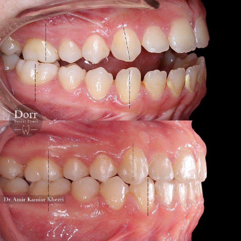 تاثیر درمان ارتودنسی در فاصله بین دندان های فک بالا و پایین
