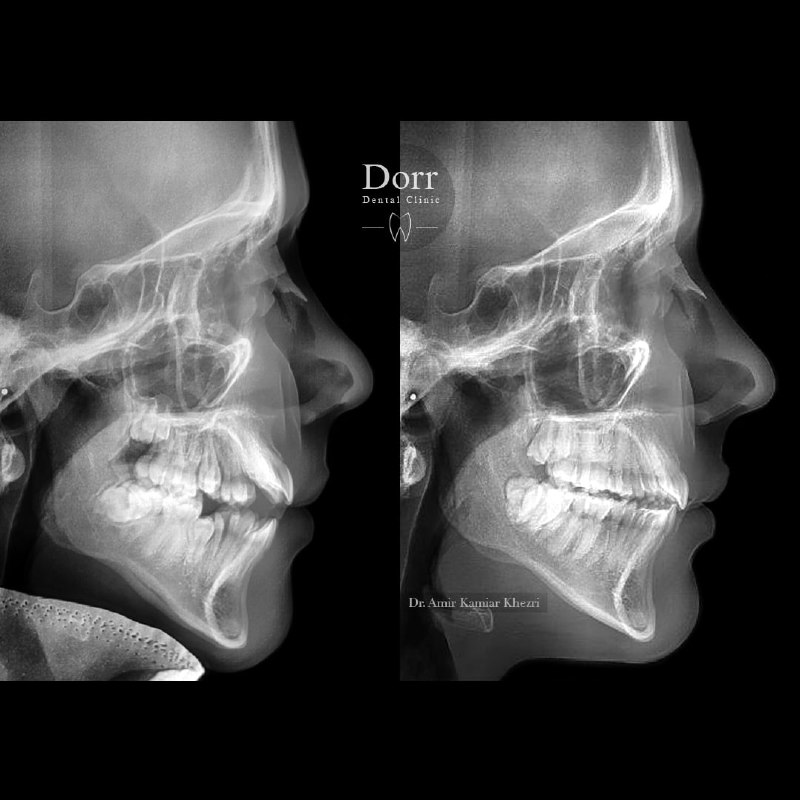 معجزه ارتودنسی (بدون جراحی فک) در بسته شدن فاصله دندان‌ها، زیبایی لبخند و مشخص شدن دندان‌های فک بالا
.