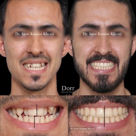 مراجعه کننده بزرگسال عزیزمون که دارای مشکل تنگی فک بالا همراه با open bite بودند، از تکنیک MARPE جهت افزایش عرض قوس فک بالا (بدون جراحی) و همچنین از mini screw جهت اصلاح open bite، شلوغی دندان‌ها و بستن فضای دندان هفت پایین استفاده شد و درمان ایشون بدون کشیدن دندان انجام گردید. (درمان ارتودنسی نیاز ایشون به ایمپلنت دندان هفت پایین را هم برطرف نمود) 