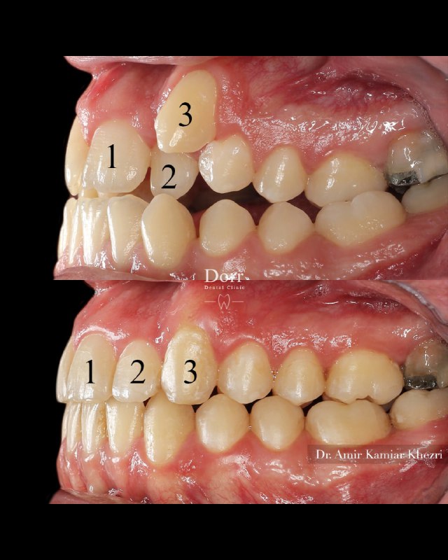 مراجعه کننده بزرگسال عزیزمون که دارای مشکل تنگی فک بالا همراه با open bite بودند، از تکنیک MARPE جهت افزایش عرض قوس فک بالا (بدون جراحی) و همچنین از mini screw جهت اصلاح open bite، شلوغی دندان‌ها و بستن فضای دندان هفت پایین استفاده شد و درمان ایشون بدون کشیدن دندان انجام گردید. (درمان ارتودنسی نیاز ایشون به ایمپلنت دندان هفت پایین را هم برطرف نمود) 