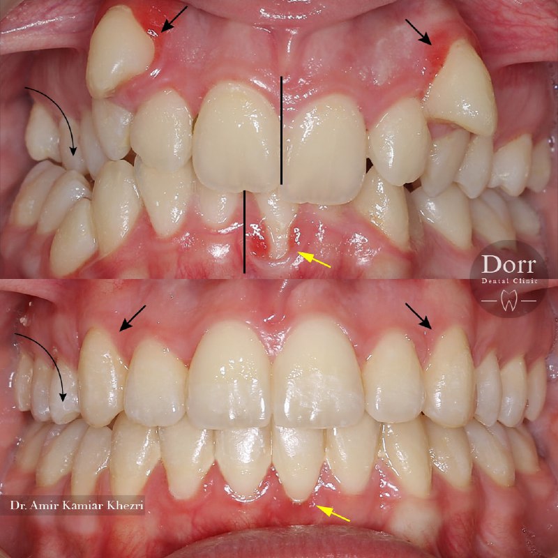  تاثیر درمان ارتودنسی ثابت بر زیبایی لبخند و همچنین در طی درمان ارتودنسی با انجام حرکات مناسب دندان‌ها، بدون انجام جراحی لثه، تحلیل لثه برطرف و اصلاح گردید.
.