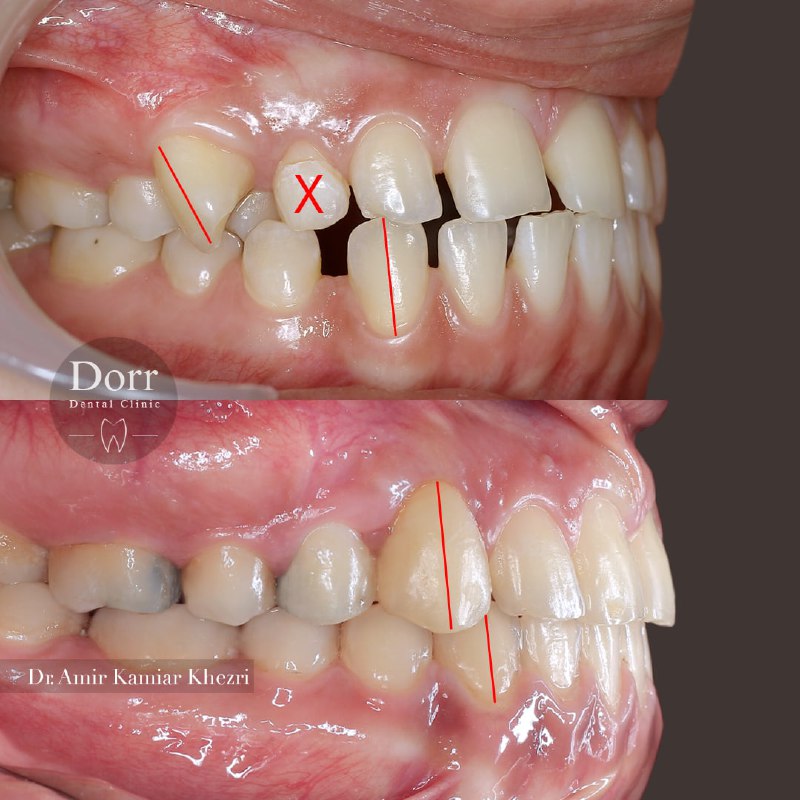 درمان ارتودنسی ثابت دو فک با کمک پیچ‌های داخل فکی جهت اصلاح جابجایی موقعیت دو دندان شماره سه ( نیش ) و چهار( پرمولر اول ). درمان جابجایی های دندانی جز درمان‌های چالش برانگیز در ارتودنسی می‌باشند.