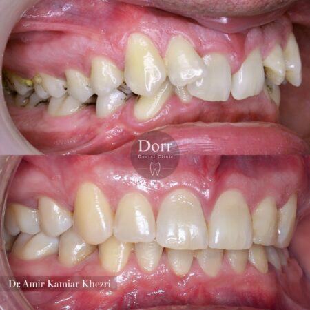  درمان ارتودنسی کاملا ایده‌آل یکی از مراجعه کنندگان عزیزمون با انواعی از مشکلات دندانی بسیار سخت و پیچیده:
.
۱ - دندان نیش نهفته سمت چپ بالا با میزان نهفگی زیاد
۲ - جابجایی دندان‌های شماره سه و چهار در سمت راست بالا
۳ - عدم مطابقت خطوط میانی دو فک  (انحراف میدلاین)
۴ - رابطه دندانی کلاس دو (عقب بودن فک پایین)
۵ - کمبود فضای زیاد در فک بالا
۶ - دندان‌های تو رفته در هنگام لبخند
