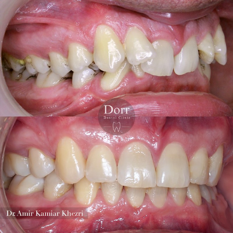  درمان ارتودنسی کاملا ایده‌آل یکی از مراجعه کنندگان عزیزمون با انواعی از مشکلات دندانی بسیار سخت و پیچیده:
.
۱ - دندان نیش نهفته سمت چپ بالا با میزان نهفگی زیاد
۲ - جابجایی دندان‌های شماره سه و چهار در سمت راست بالا
۳ - عدم مطابقت خطوط میانی دو فک  (انحراف میدلاین)
۴ - رابطه دندانی کلاس دو (عقب بودن فک پایین)
۵ - کمبود فضای زیاد در فک بالا
۶ - دندان‌های تو رفته در هنگام لبخند