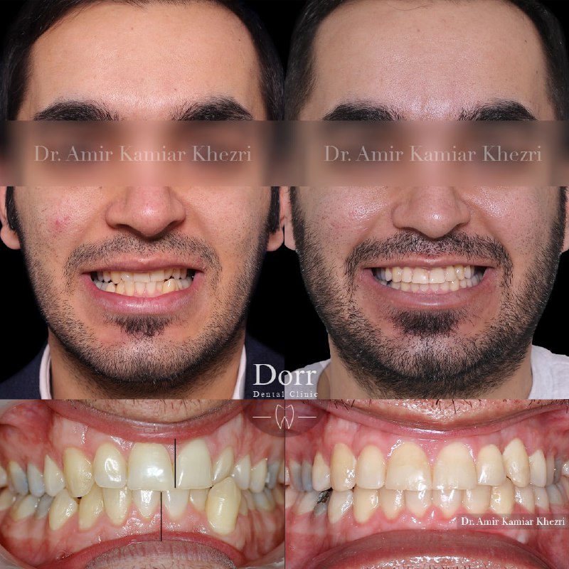 عکس قبل و بعد از ارتودنسی دندان بدون کشیدن دندان