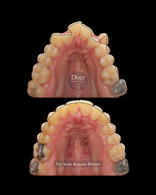 مراجعه کننده بزرگسال عزیزمون که دارای مشکل تنگی فک بالا همراه با open bite بودند، از تکنیک MARPE جهت افزایش عرض قوس فک بالا (بدون جراحی) و همچنین از mini screw جهت اصلاح open bite، شلوغی دندان‌ها و بستن فضای دندان هفت پایین استفاده شد و درمان ایشون بدون کشیدن دندان انجام گردید. (درمان ارتودنسی نیاز ایشون به ایمپلنت دندان هفت پایین را هم برطرف نمود) 