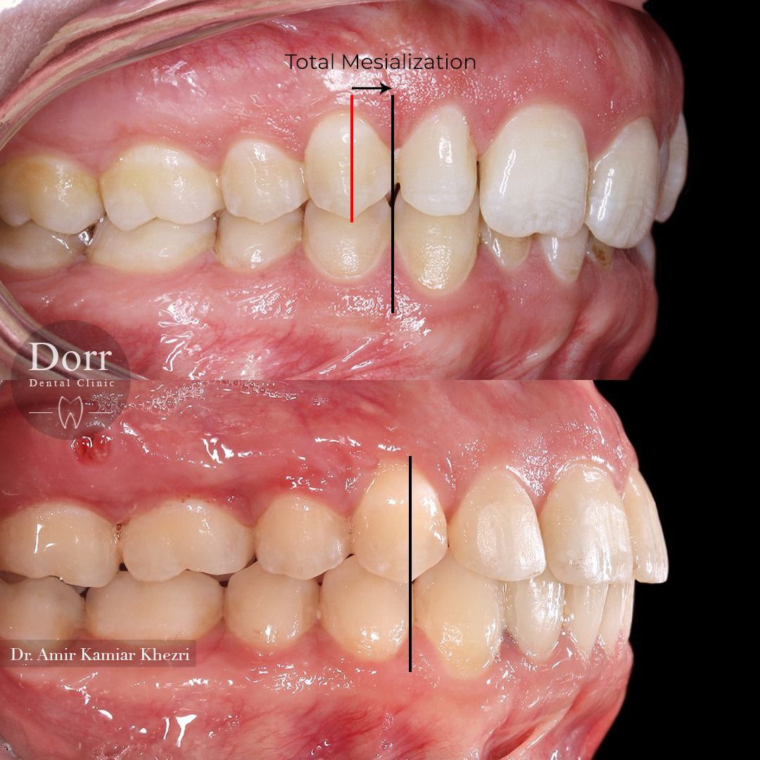یکی از دلایل اصلی انحراف میدلاین (خط میانی دندان‌ها) در فک بالا، کشیدن یک طرفه دندان در سنین پایین تر هست و این انحراف تاثیر بسیار بالایی بر روی ناقرینگی و بهم خوردن زیبایی لبخند دارد.
.
در صورت وجود این مشکل تنها روش درمانی، درمان ارتودنسی می باشد و با هیچ کدام از درمان‌های زیبایی قابل اصلاح نیست.
.
همانطوریکه ملاحظه میفرمایید این عدم قرینگی در این مراجعه کننده عزیزمون ، با درمان ارتودنسی بدون کشیدن دندان و با کمک پیچهای داخل فکی ( TAD system) بطور کامل اصلاح شده است .
پ.ن: دندان‌های شماره دو به دلیل کوچکی سایز با درمان زیبایی (کامپوزیت) اصلاح  شده‌
اند .