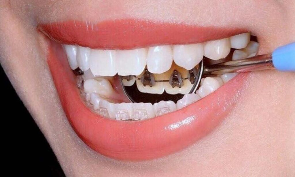 ارتودسی لینگوال - ارتودنسی پشت دندانی