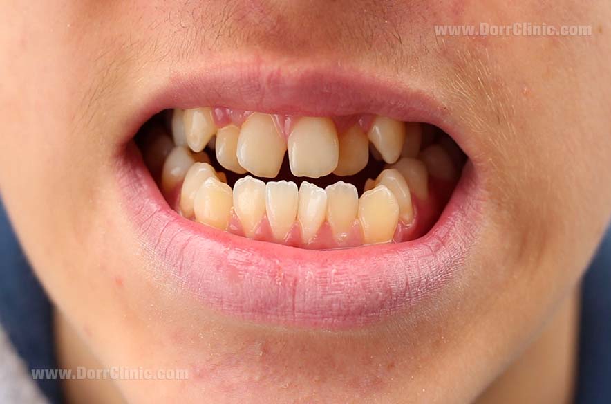 مال اکلوژن مال اکلوژن