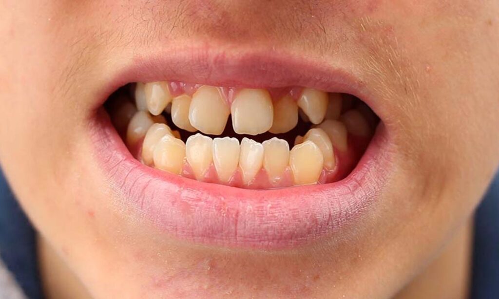 مال اکلوژن چیست مال اکلوژن چیست