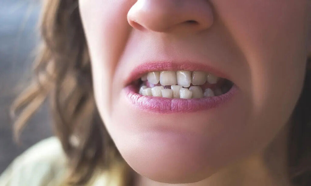 علت کج شدن دندان ها چیست؟