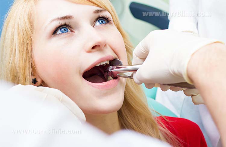 tooth extraction tooth extraction
