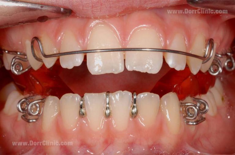 Functional Orthodontics Functional orthodontics advantages