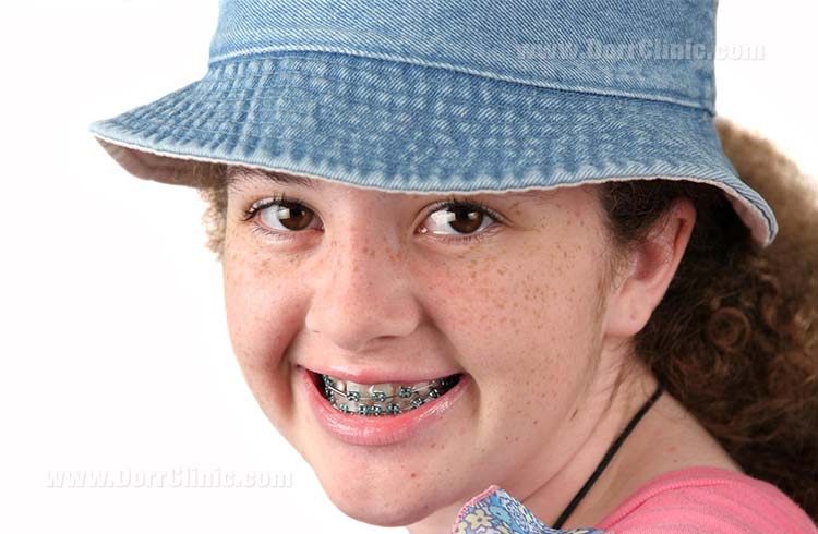 wearing braces during childhood wearing braces during childhood