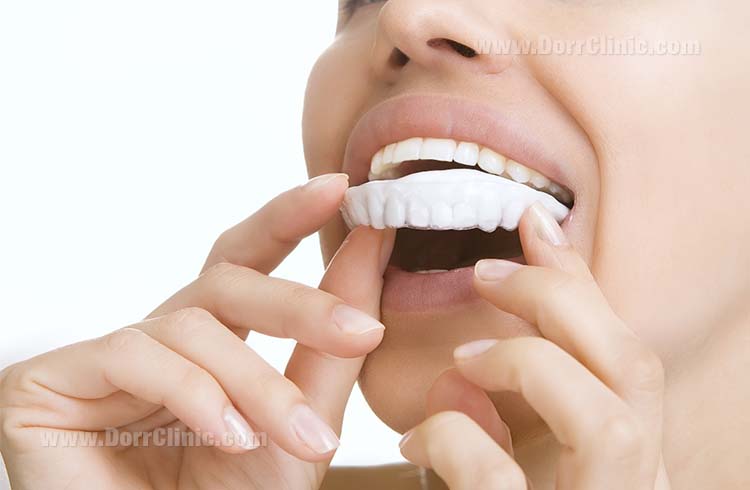  Tooth whitening molds
