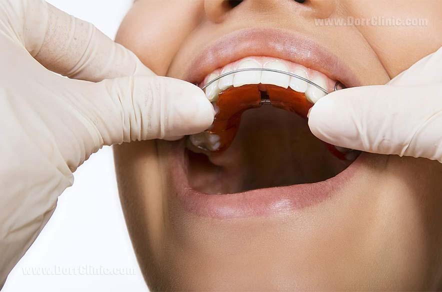Removable appliance Removable appliance