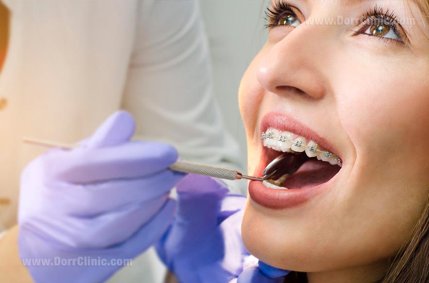 بهداشت دندان ارتودنسی
