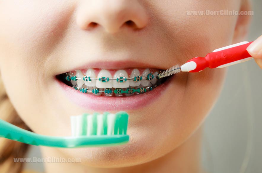 بهداشت دندان ارتودنسی