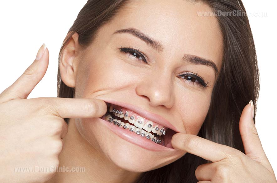 اجزای ارتودنسی اجزای ارتودنسی