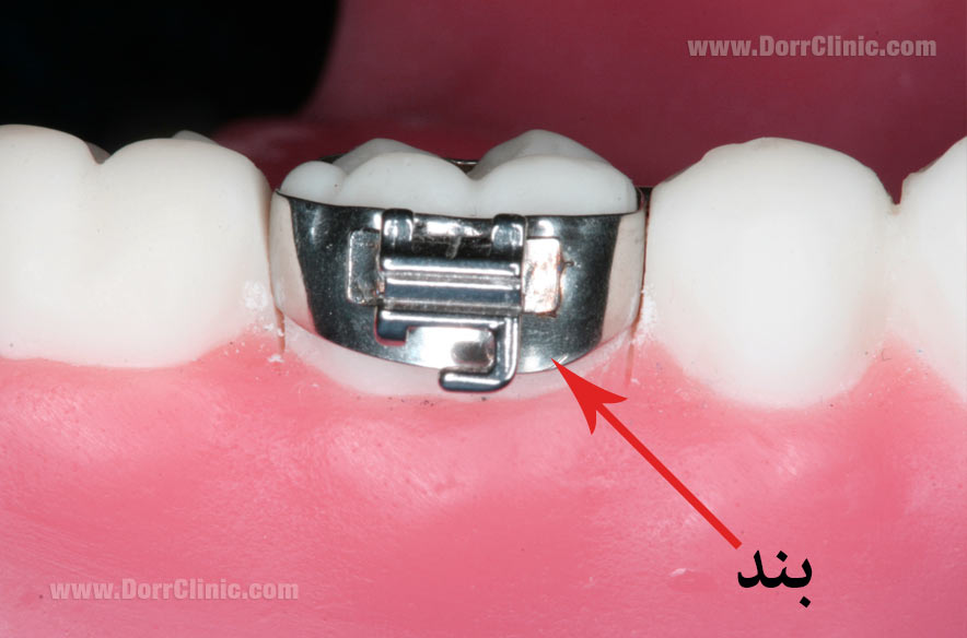 بند ارتودنسی