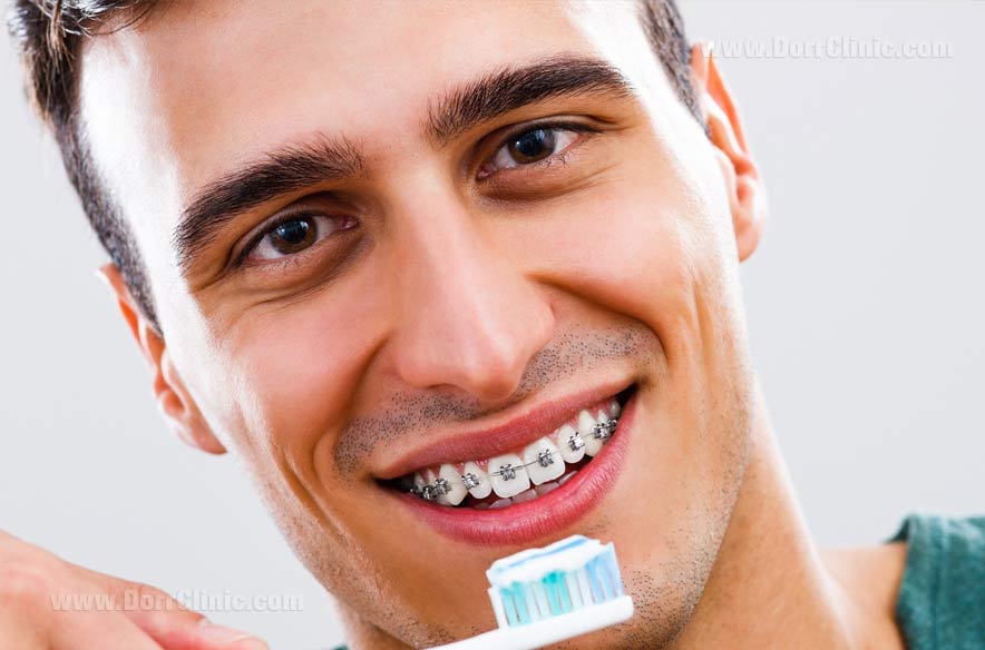 مراقبت از دندان ها پس از ارتودنسی