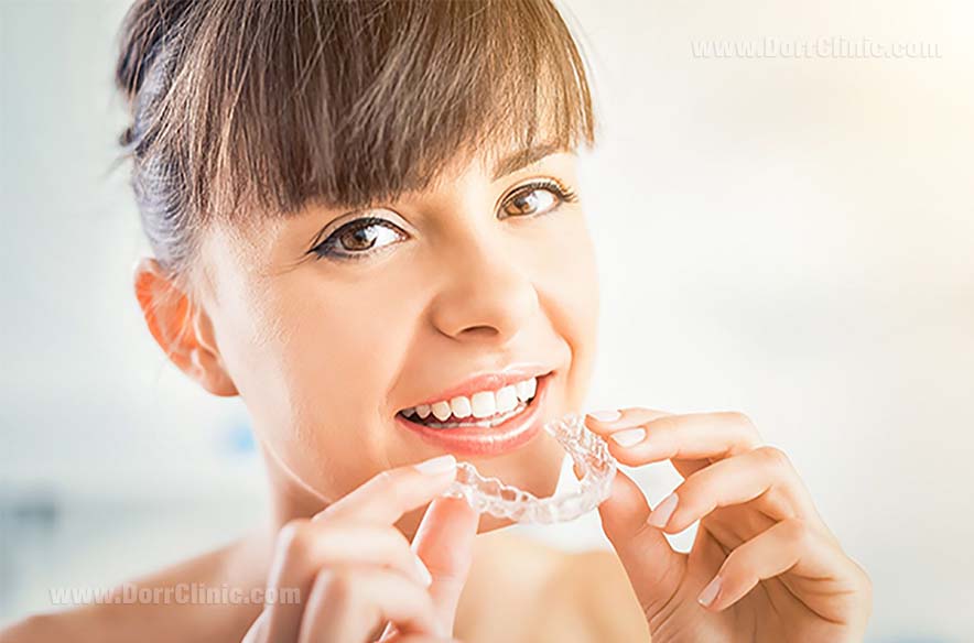 Invisalign brace Invisalign brace