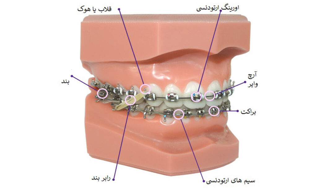 اجزای ارتودنسی اجزای ارتودنسی