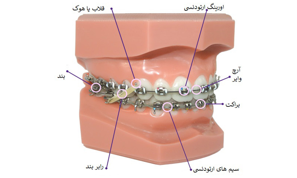 اجزای ارتودنسی