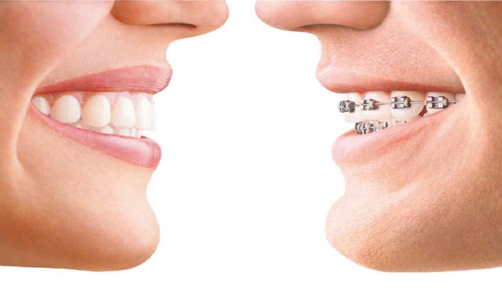 مدت زمان ارتودنسی دندان چقدر است؟