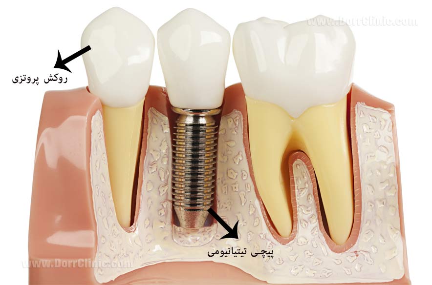 ارتودنسی دندان های ایمپلنت شده