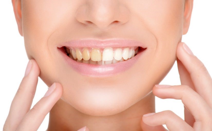 veneers whitening Dr. Ghorbani Aesthetic & Restorative specialist
