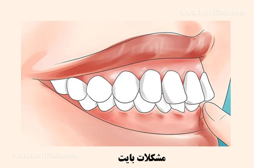 مشکلات بایت