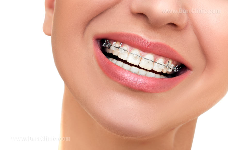 ارتودنسی روی کامپوزیت ارتودنسی روی کامپوزیت