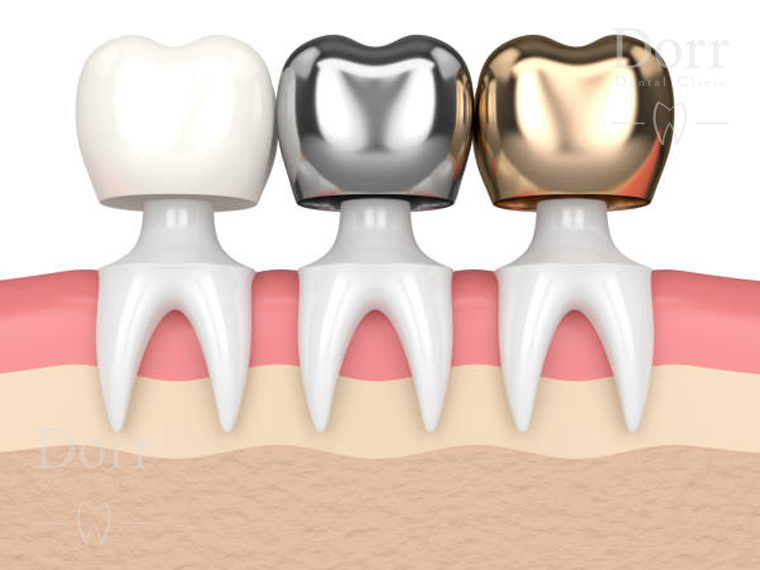dental crown 