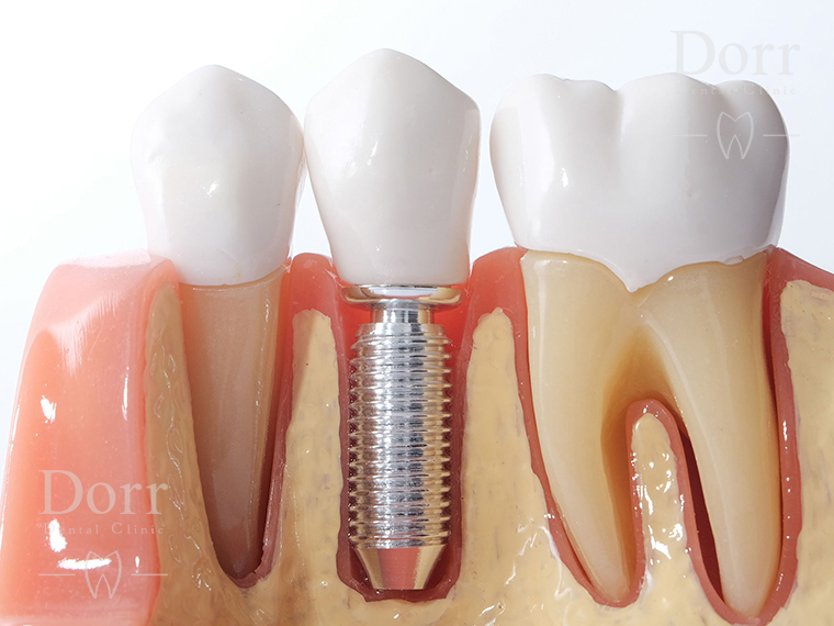Dental implant Dental implant