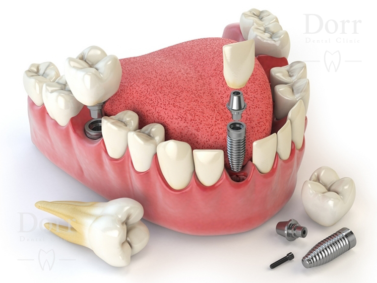 dental implant surgery procedure