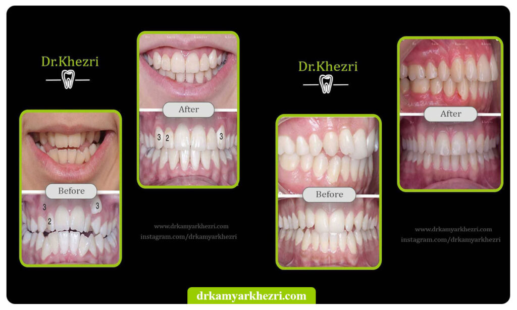 عکس ارتودنسی دندان قبل و بعد