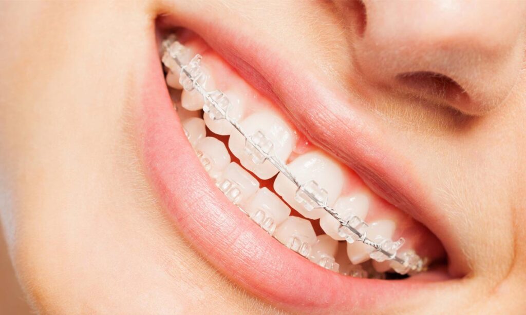 همه چیز درباره ارتودنسی سرامیکی همه چیز درباره ارتودنسی سرامیکی