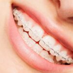 همه چیز درباره ارتودنسی سرامیکی