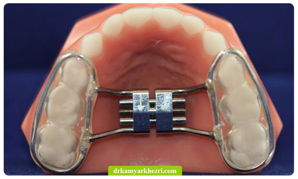 Аппарат для расширения челюсти для детей