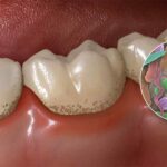 عفونت دندان چیست و چه علائمی دارد