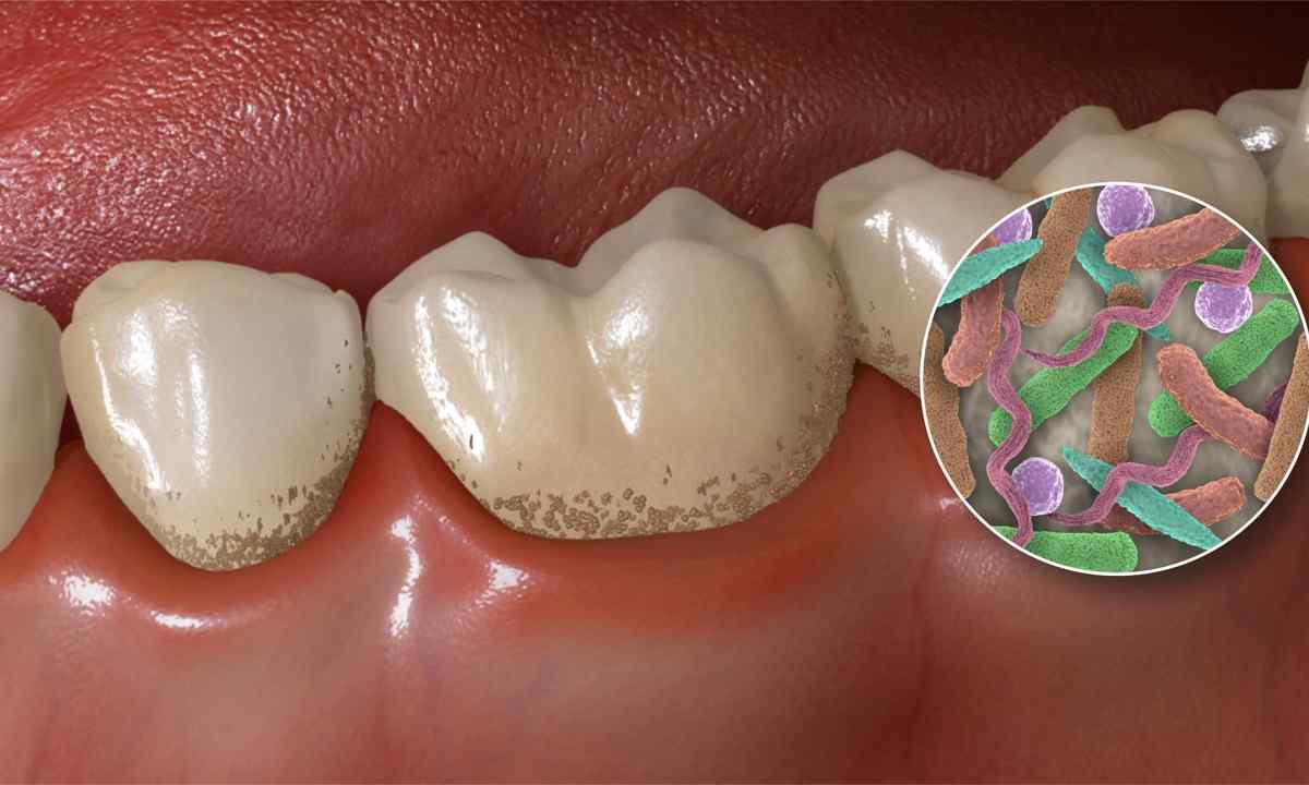 عفونت دندان چیست و چه علائمی دارد