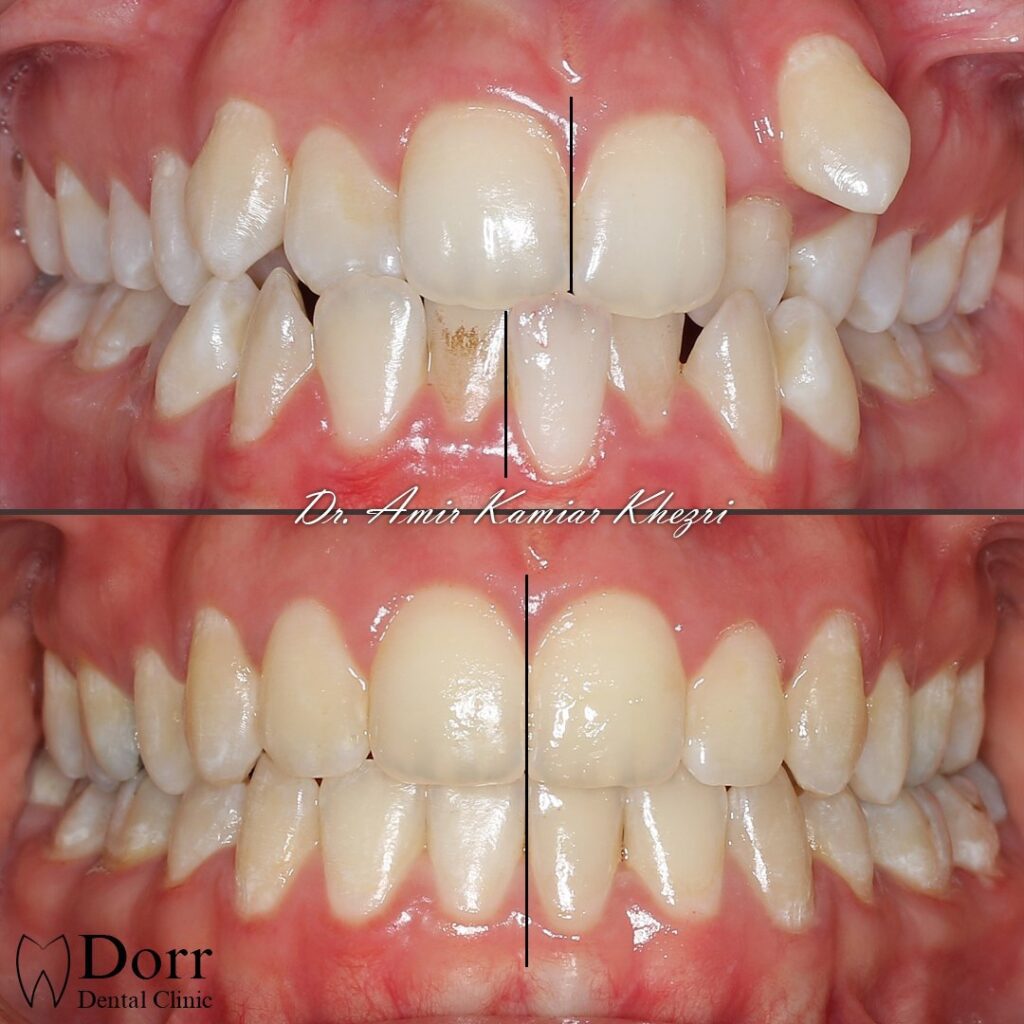orthodontics-dr-khezri-15-1